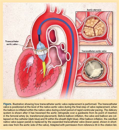 Aortic Stenosis What Long Term Care Providers Need To Know