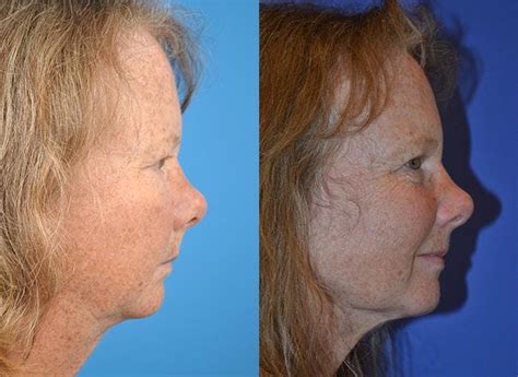 Patient 122406522 Laser Assisted Weekend Neck Lift Before And After