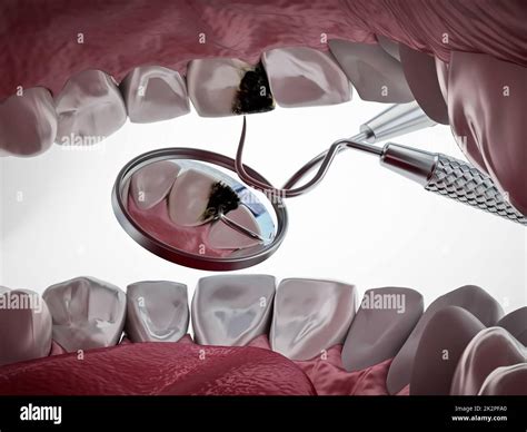 Decayed Tooth Diagnosis And Treatment 3d Illustration Stock Photo Alamy