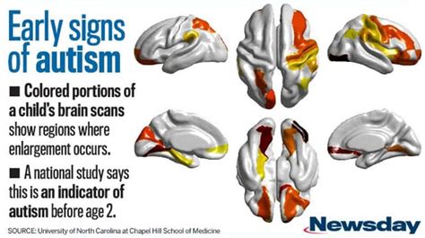 Brain Scans Show Early Signs Of Autism In High Risk Children Newsday