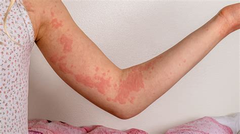 Urticaria Hives In Children Symptoms Rash Causes Trea