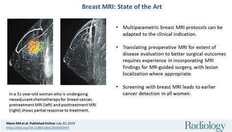 Breast Mri State Of The Art Radiology