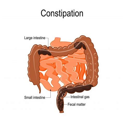 symptoms and types constipation