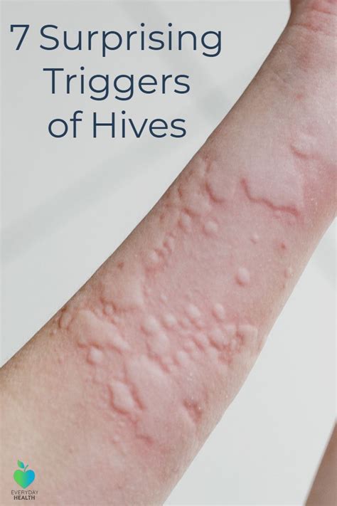 7 Surprising Triggers Of Chronic Hives Chronic Hives Hives Remedies Natural Remedies For Hives