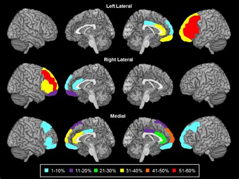 Damage To Frontal Lobe Regions For Each Frontal Patient Subgroup