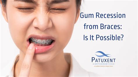 Gum Recession From Braces Is It Possible