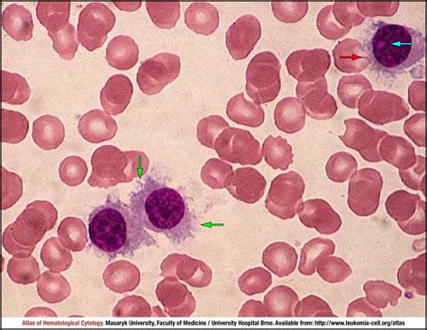 Splenic Marginal Zone Lymphoma Cell Atlas Of Haematological Cytology