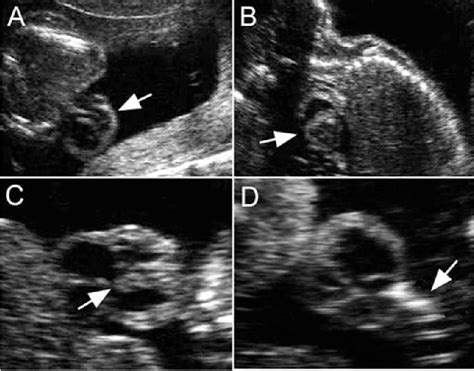 Figure 1 From Prenatal Diagnosis Of Thoracic Ectopia Cordis By Real