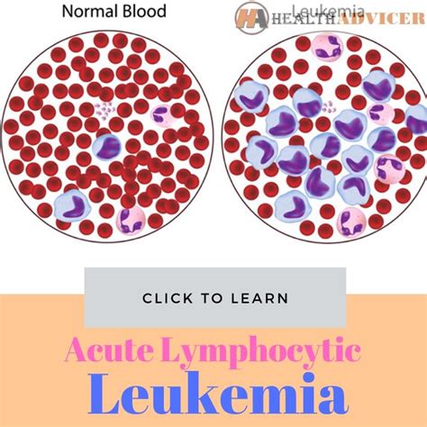 Acute Lymphocytic Leukemia Causes Symptoms And Treatment