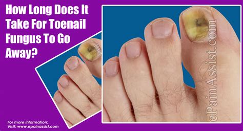 How Long Does It Take For Toenail Fungus To Go Away