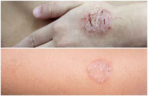 Nummular Eczema Vs Ringworm Symptoms Causes Diagnosis Treatment