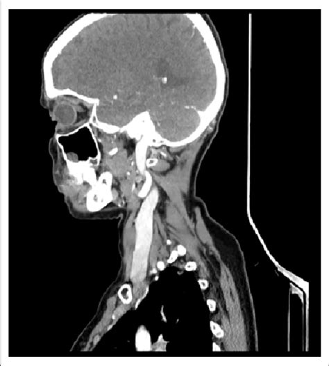 Sagittal Contrast Enhanced Ct Image Of The Neck Showing A Well Defined