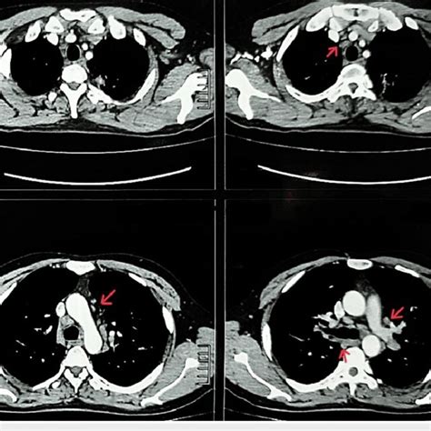 High Resolution Computed Tomography Of The Chest Axial View Showing