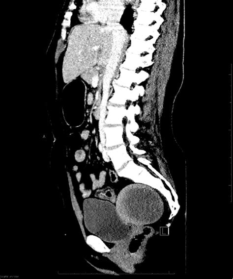 CT scan of the abdomen: image of uterine leiomyoma, no signs of active