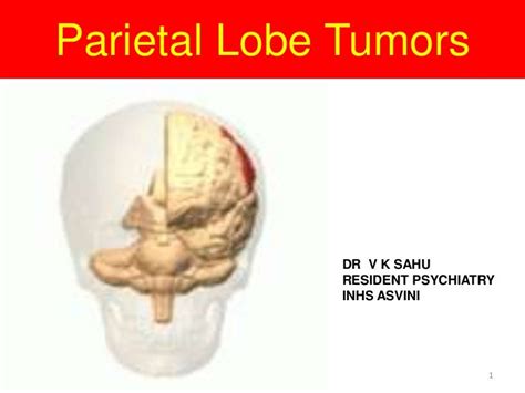 Parietal Lobe Tumor