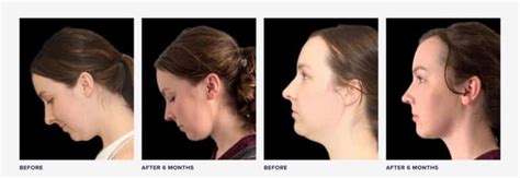 I Got A Neck Lift At 25 To Remove A Genetic Double Chin Realself News