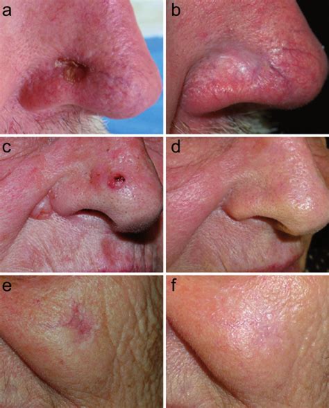 Representative Outcomes Of The Treatment Of Basal Cell Carcinoma Bcc