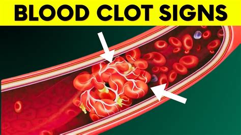 Dont Ignore These 10 Early Warning Signs Of Blood Clots You Need To
