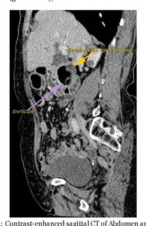 Figure 5 From A Duodenal Diverticula Causing A Lemmel Syndrome A Case