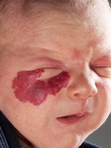 Compva Infantile Hemangioma Face With Rebound During Propranolol Therapy