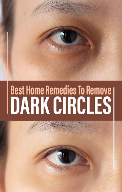 Dark Circles Under The Eyes Causes Symptoms And Treatment Options