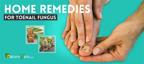 9 Best Home Remedies For Toenail Fungus To Prevent Infection