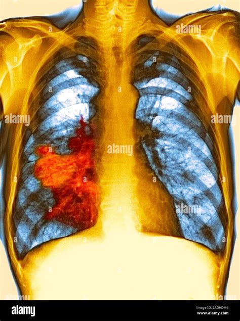 Lung Cancer Coloured Chest X Ray Showing A Large Tumour Red Due To