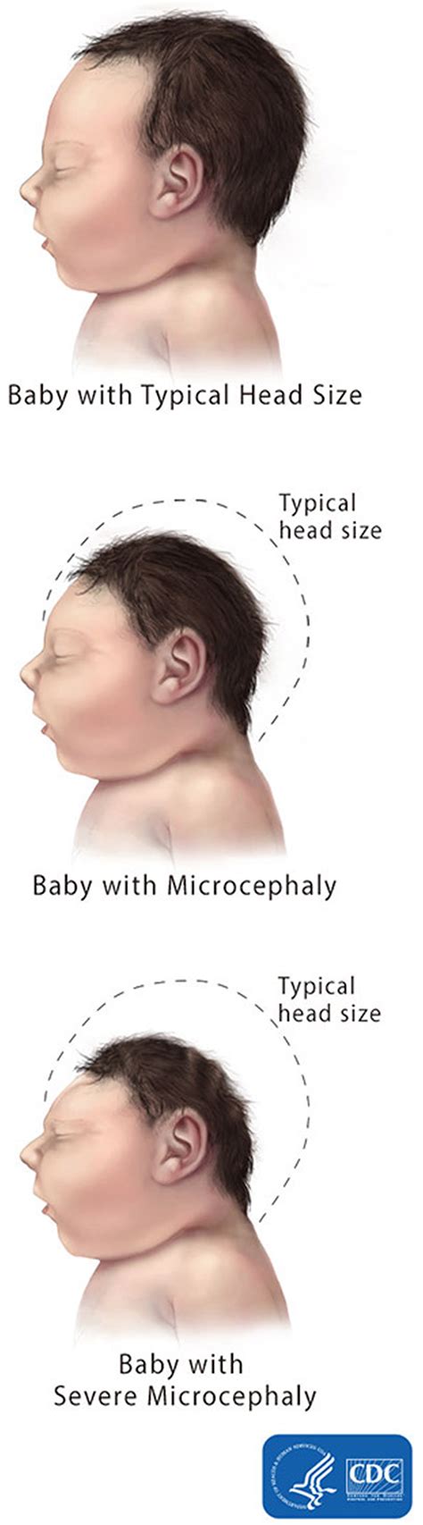 Microcephaly Causes Symptoms Diagnosis Prognosis Treatment