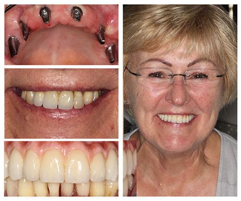 Teeth Whitening Camden Place Dental Practice Preston