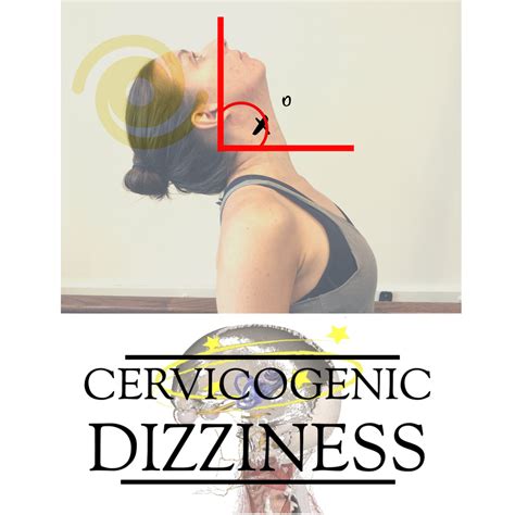 Cervicogenic Dizziness Diagnosis Treatment And Course — Integrative