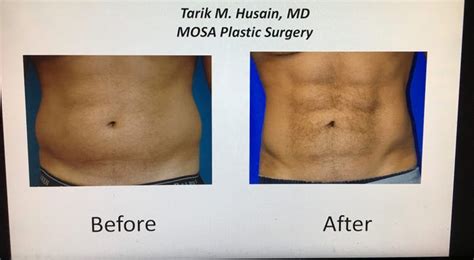A Liposuction Procedure Promises 6 Pack Abs Without Lifting A Finger