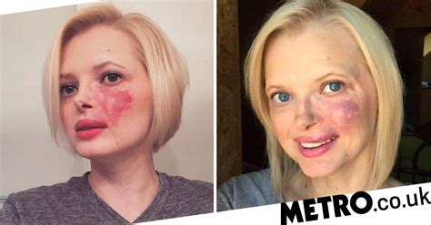 Woman Who Faced Years Of Bullying Finally Embraces Her Giant Birthmark