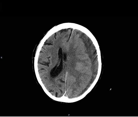 Chronic Subdural Hematoma CSH Is Still An Important Clinical Problem