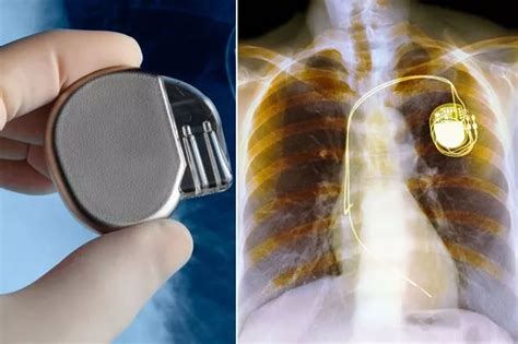 Scientists Develop Battery Free Pacemaker Powered By Energy From