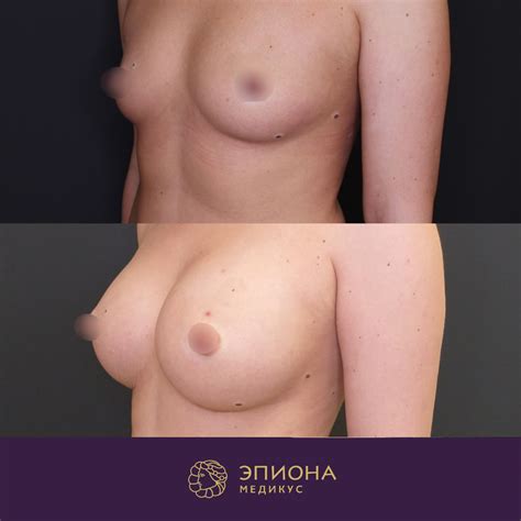 Эндопротезирование груди Клиника пластической хирургии и косметологи