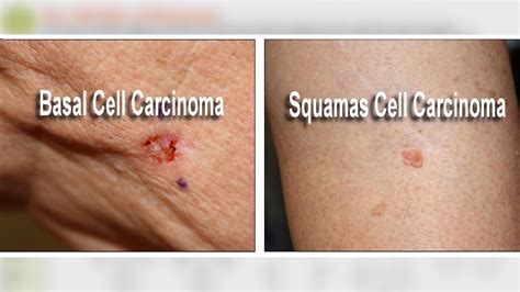 Do You Know All Of The Different Types Of Skin Cancers And Precancers Images
