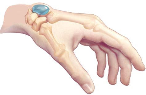 Ganglion Cyst On Dorsal Side Of Wrist Ganglion Cysts Information