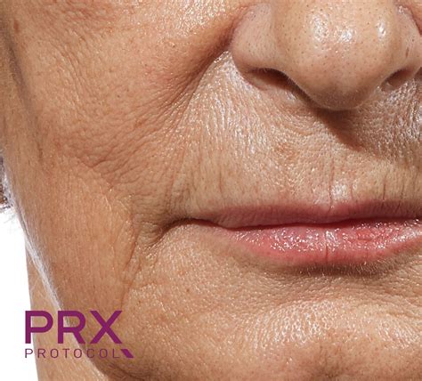 Prx T33 Peel — Ideal Skin Medspa