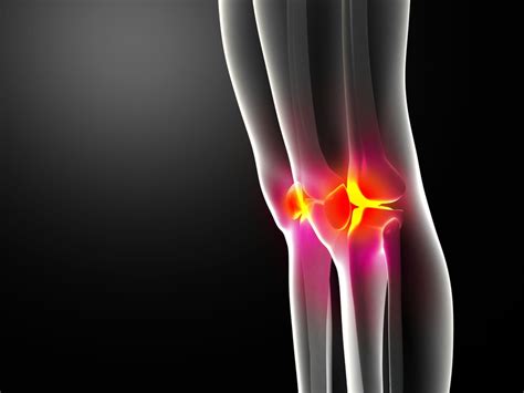 Ein knie bluterguss ist eine sehr häufig auftretende sportverletzung. Meniskus Innenbandriss - Symptome, Therapie & Folgen ...