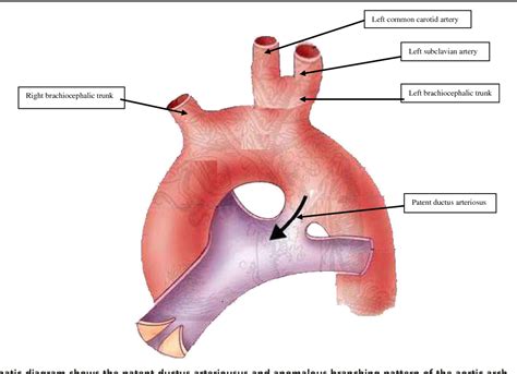 Figure 1 From Co Existence Of Patent Ductus Arteriosus And Left