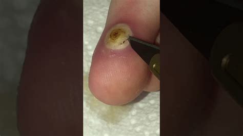Huge Wart Popping Cutting Off Very Satisfying Youtube