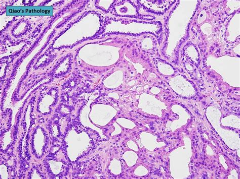 Qiao S Pathology Intraductal Papilloma Of The Breast With Apocrine