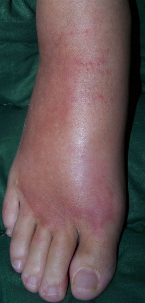 Appearance Of The Case Patients Right Foot Hot Red Open I