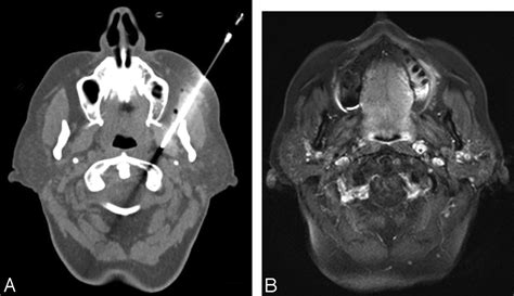 Retropharyngeal Lymph Node Metastasis From Esthesioneuroblastoma A