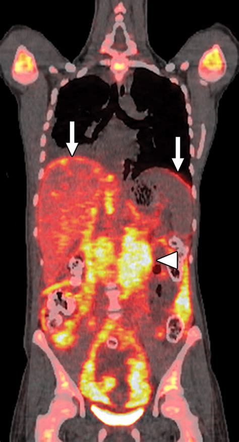 Clinical Utility Of Petct In Lymphoma Ajr