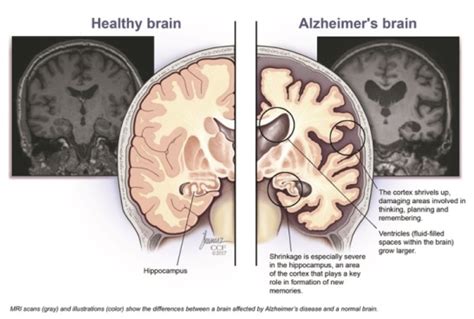 How Alzheimers Affects The Brain Sensations Memory Care Residence