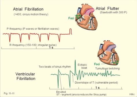 Cardiac Action Potentials And Disorders Mednotedk