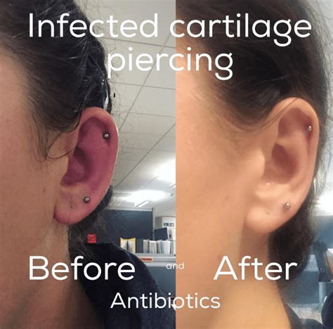 What Does An Infected Ear Piercing Look Like Ear Piercing Infection Identification And Treatment