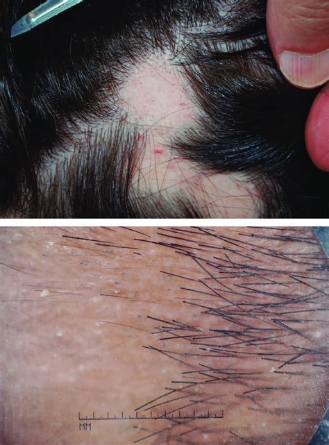 4 Alopecia Areata With A Close Up Examination Of Scalp Hair Follicles