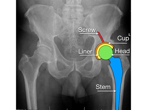 Direct Anterior Hip Arthroplasty Rodriguez Hip And Knee